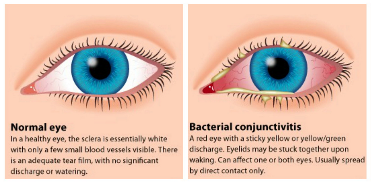 treating-pink-eye-online-simple-cheap-professional-clinic-pink-eye